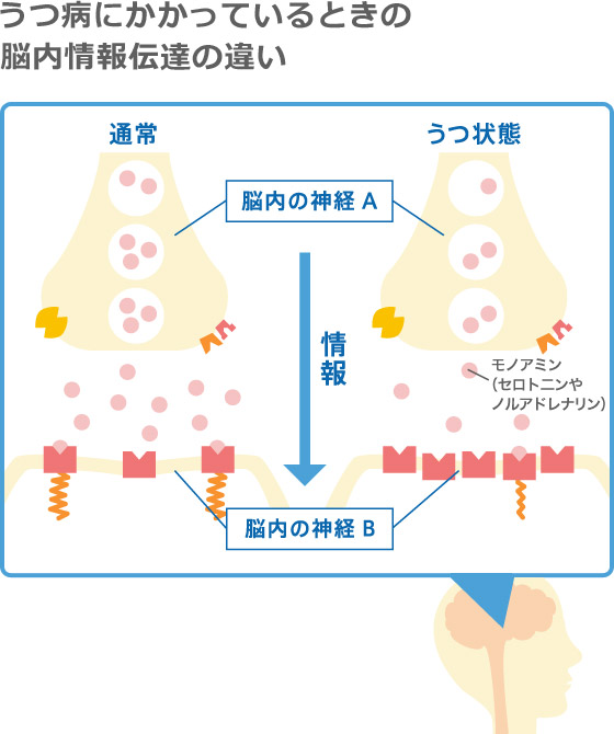 うつ病にかかっているときの脳内情報伝達の違い